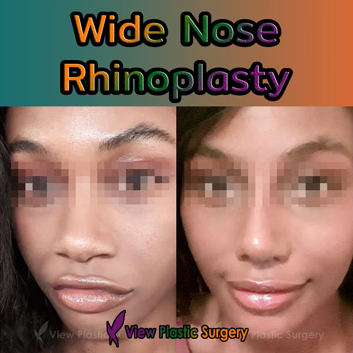 WIDE NOSE. View Plastic Surgery designs a nose… by VIEW PLASTIC