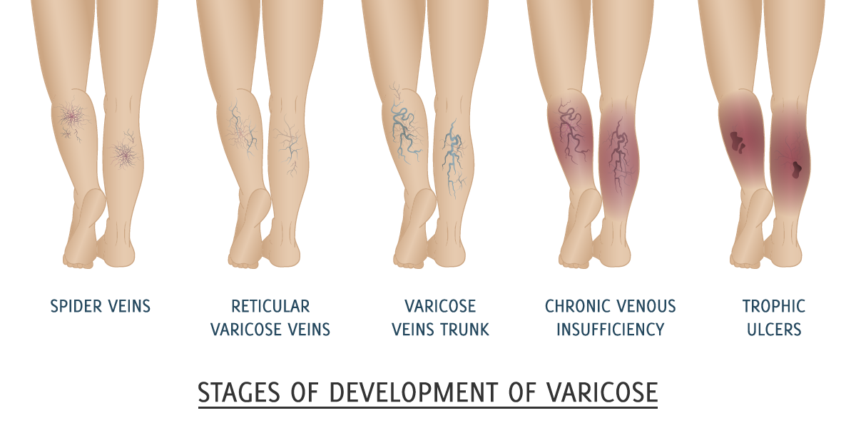 What are Varicose Veins?. Varicose veins are primarily swollen… | by St  Johns Vein Center | Medium