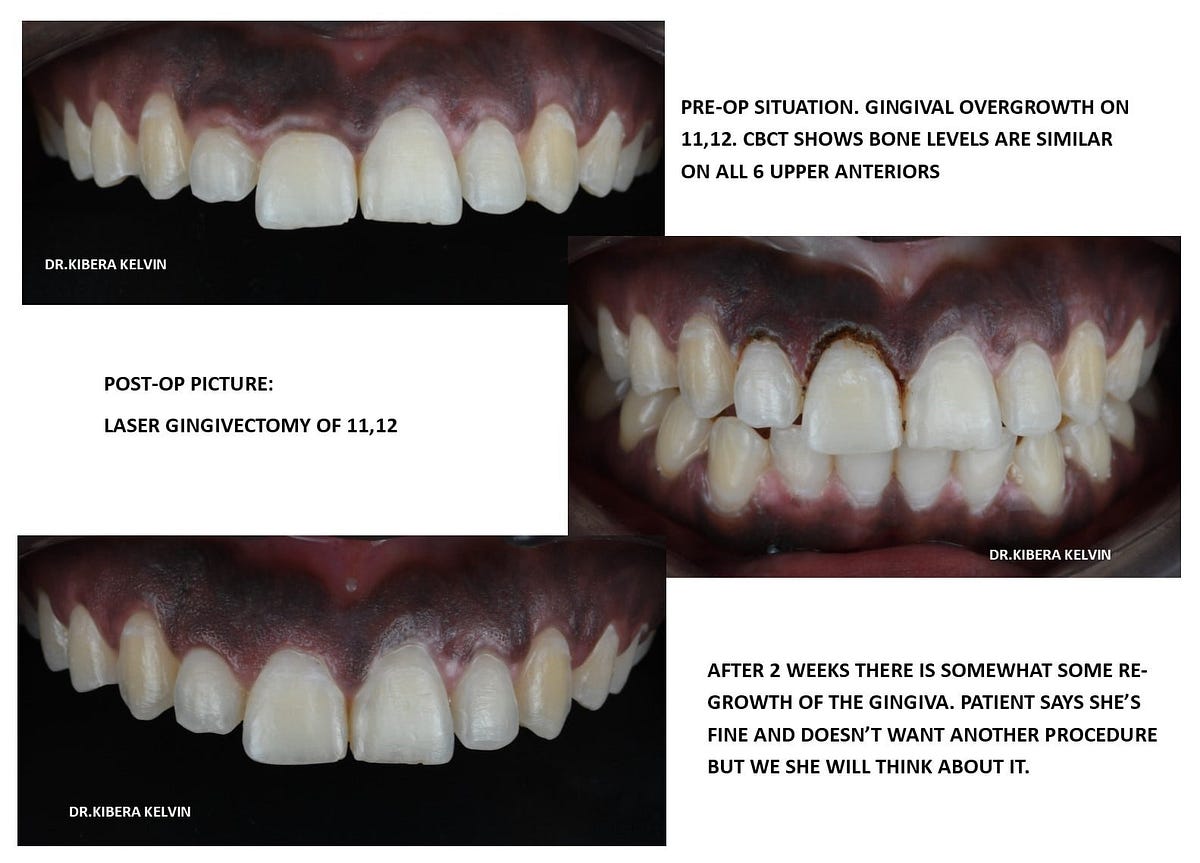 Gum reduction for cosmetic dentistry by Implants and Braces Ke Medium