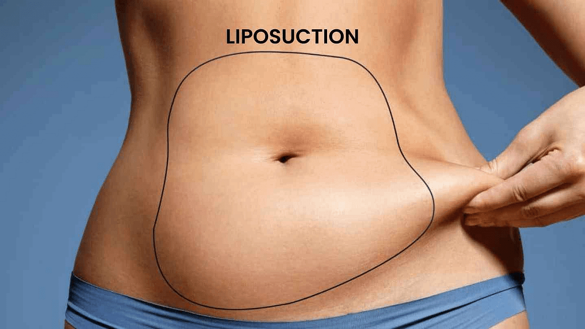 How Much Does Liposuction Cost How Much Does Liposuction Cost By How much does liposuction cost how much does liposuction cost by