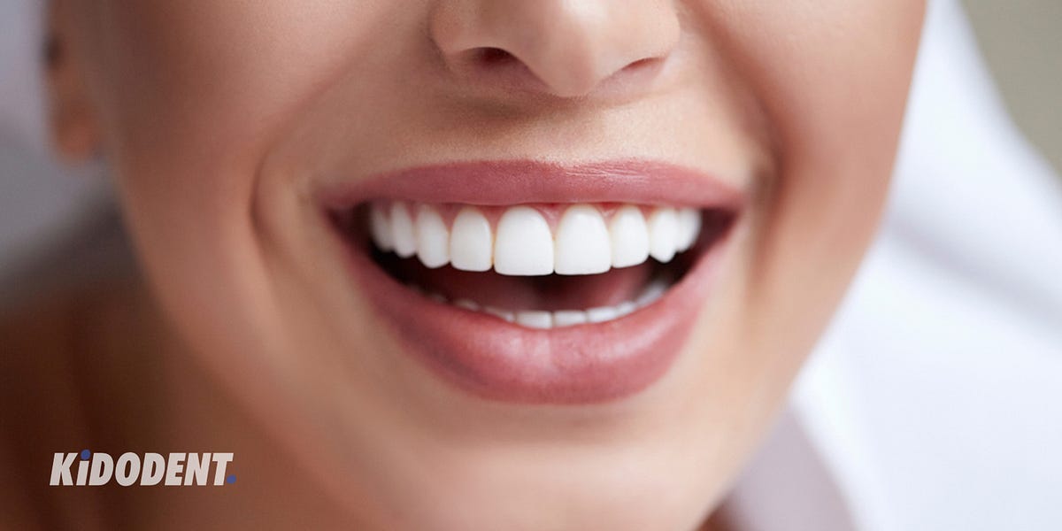 Temporary veneers (snapon/DIY veneers) what are they