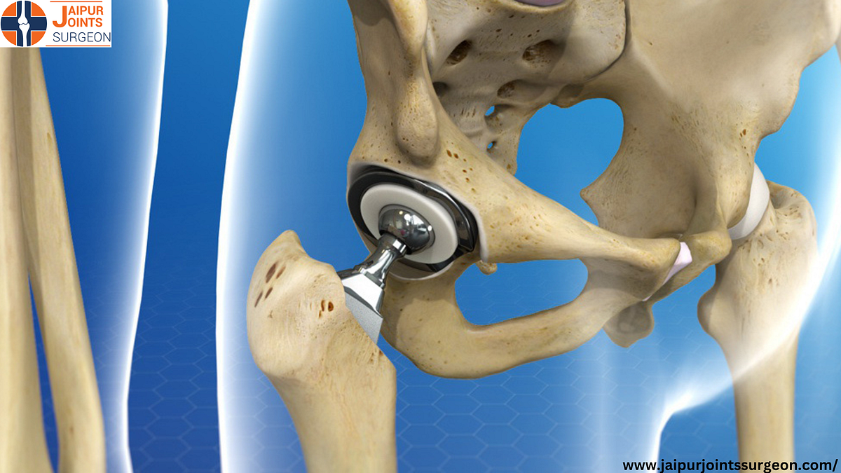 Best Hip Replacement Surgery & Treatments In Jaipur by Dr Ashish Rana