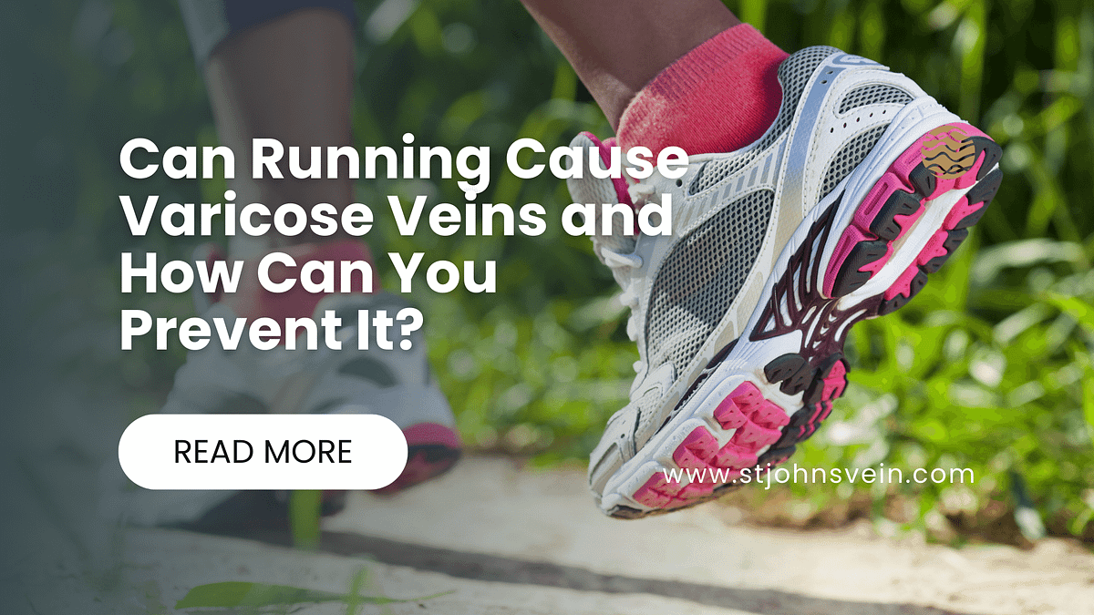 Can Running Cause Varicose Veins and How Can You Prevent It? by St