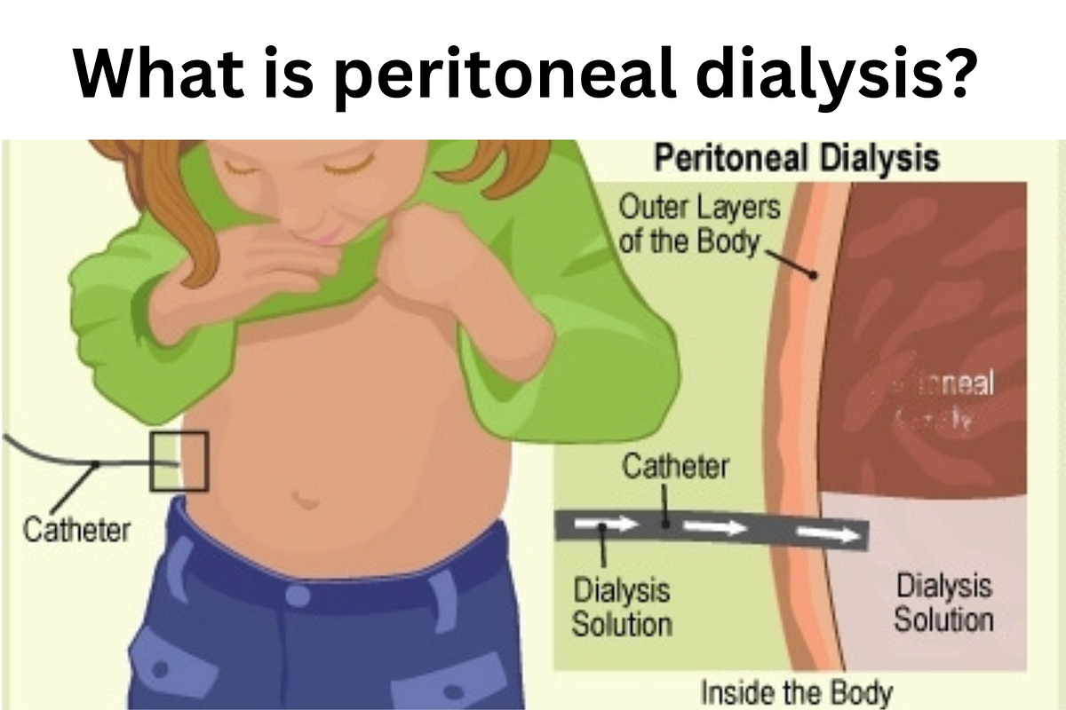 Peritoneal dialysis is increasingly popular in Kenya to treat kidney failure. by