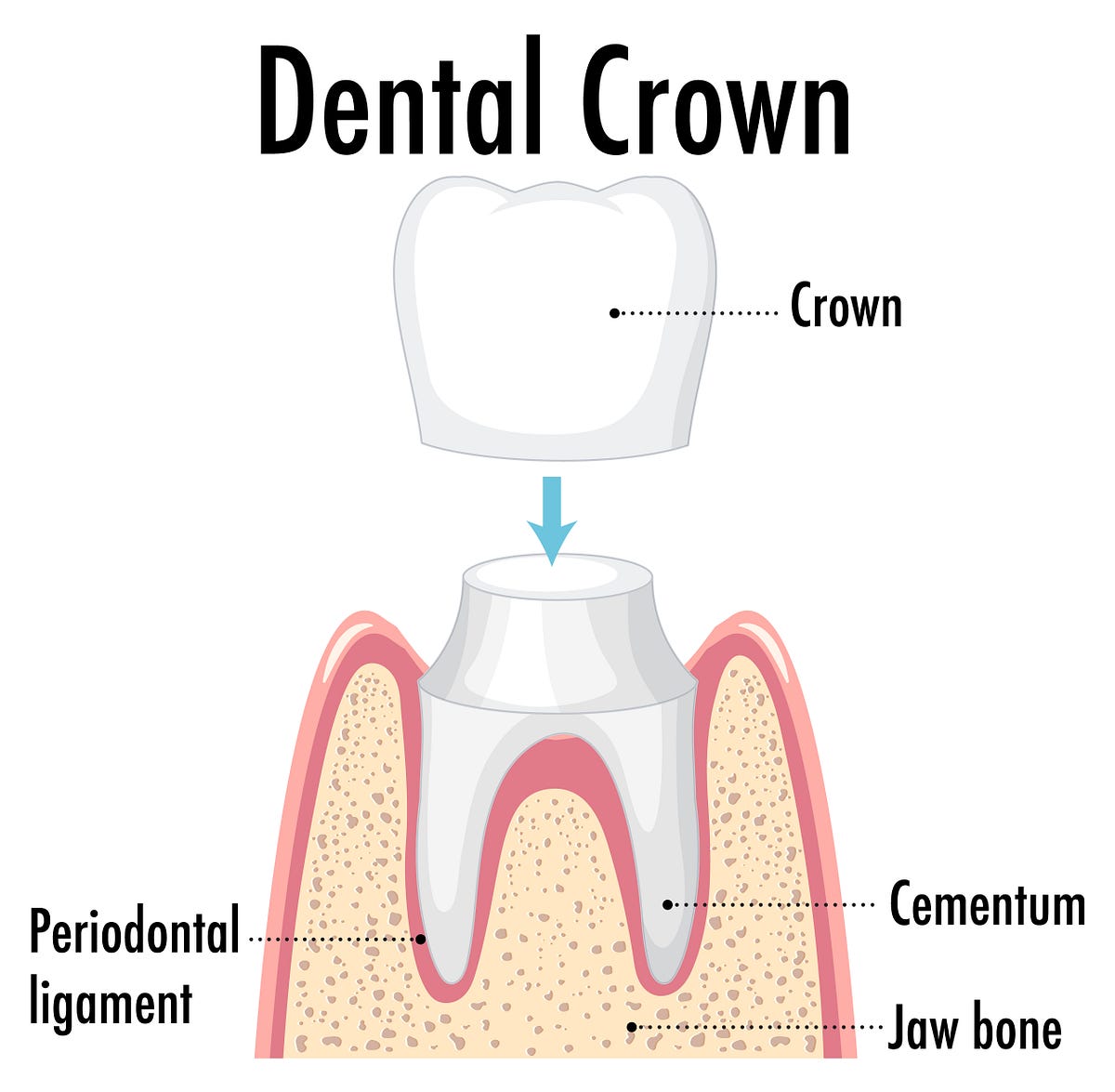 What type of dentist is best for crowns? by Dentusfamily Dental Medium