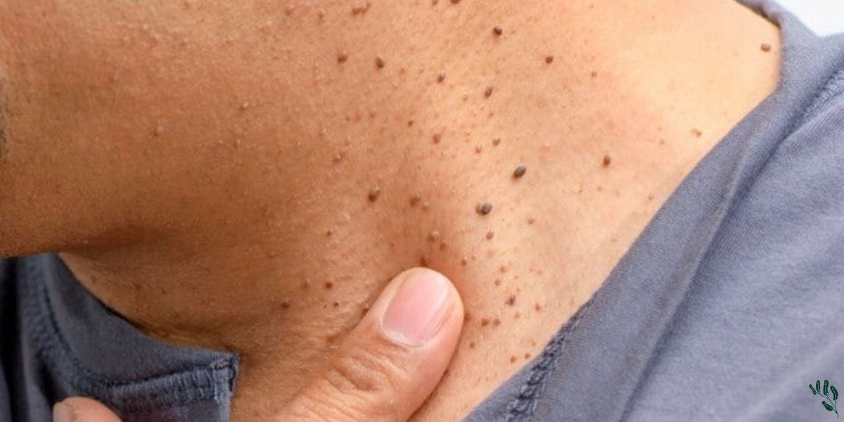 Skin Tags (Acrochordon): Causes and Treatment