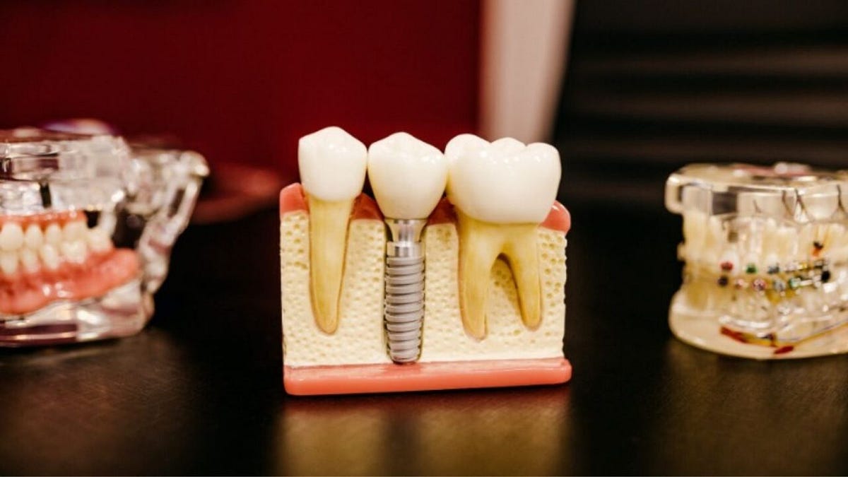 5 Motivational Reasons Why Dental Inserts Are Best For You by Tide