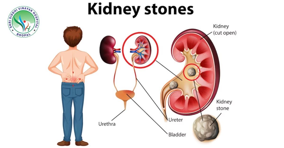 Kidney Stone Surgery A Solution to the Painful Problem by Dr. Neeraj