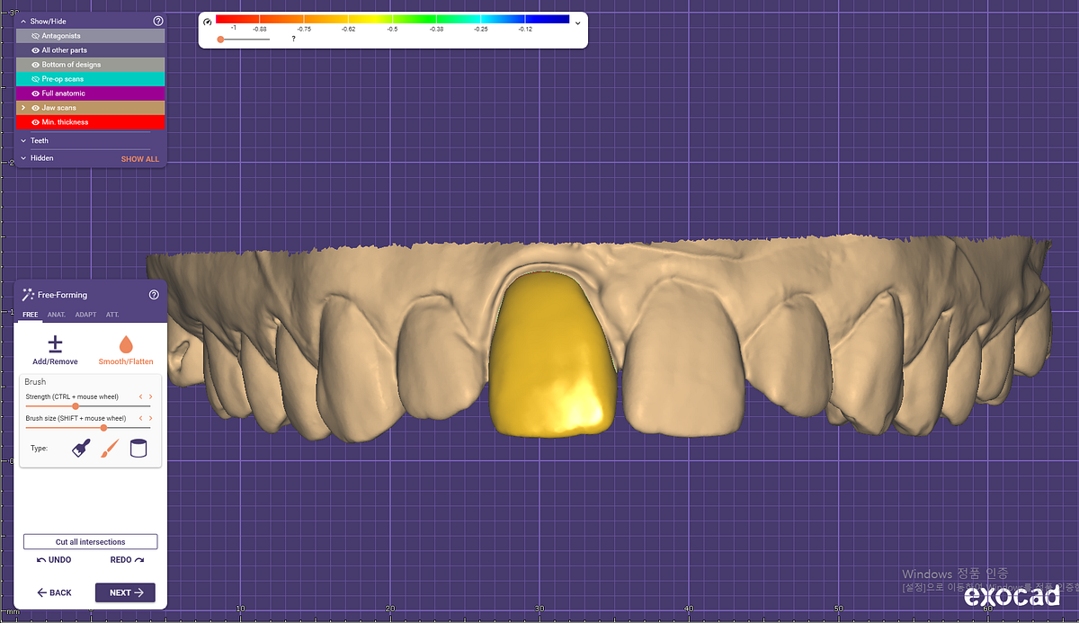 Week 3 Day 3 Dental Inlay, Onlay, and Veneer Theory and Practice by JL Medium