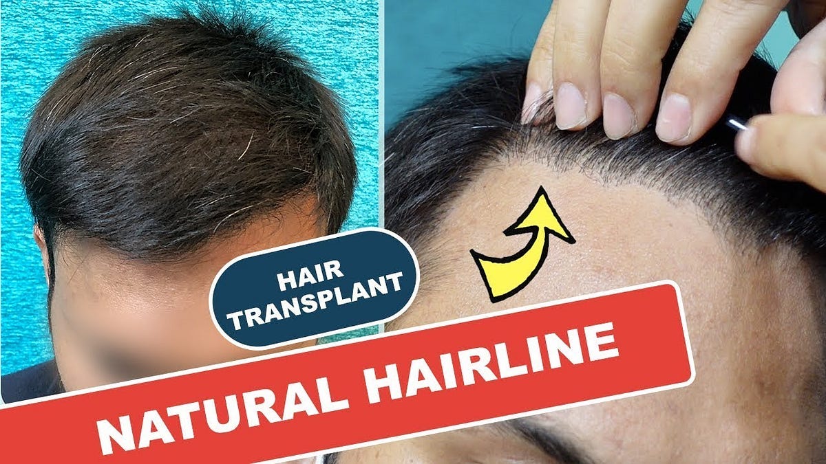 Before/After Hair Transplant With 2200 Grafts by Skin Qure Hair