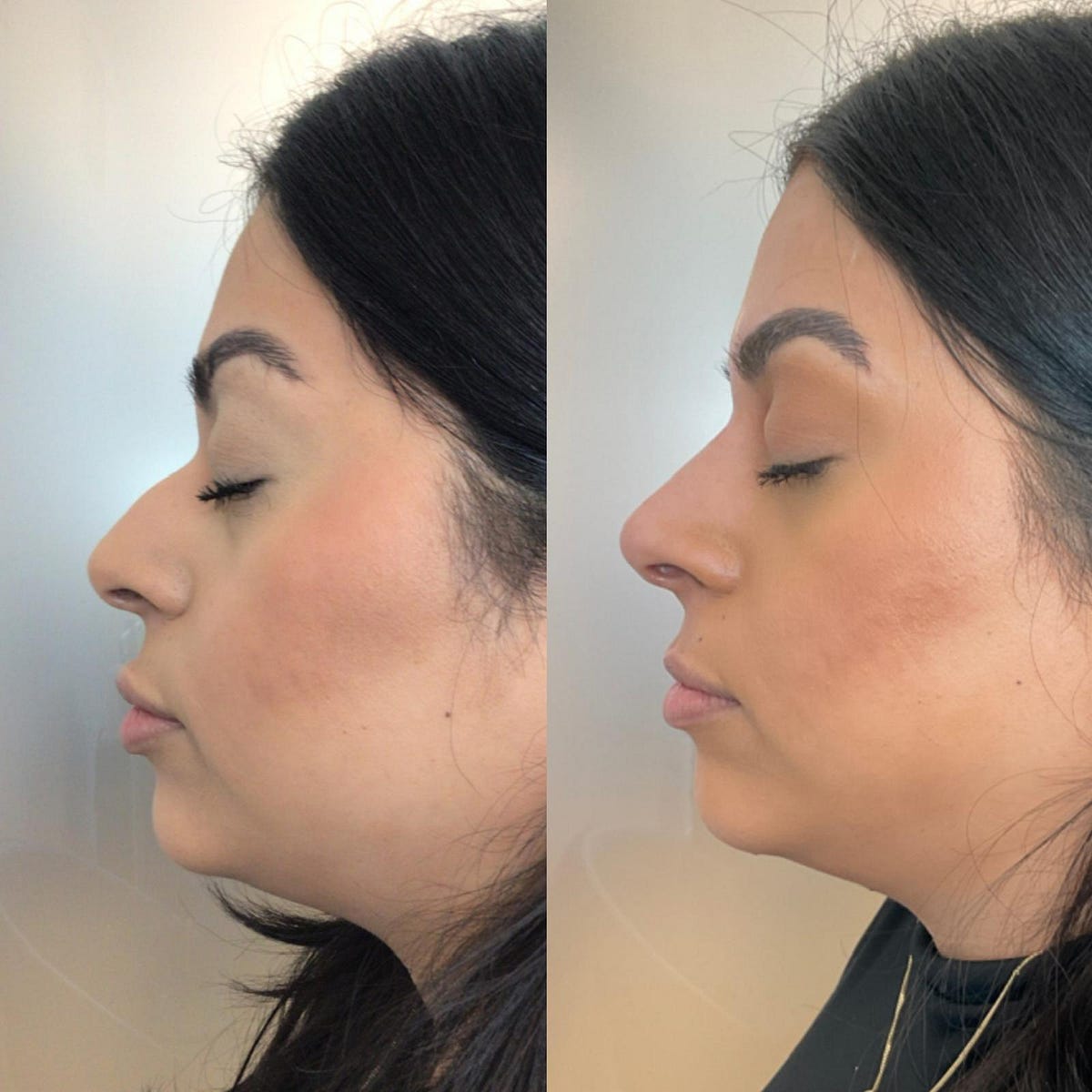 Nose Filler Miami Miami Wellness & Aesthetic Center Medium