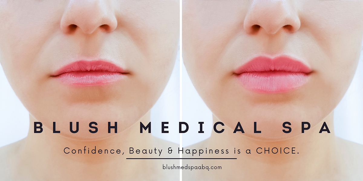 Lip Beautification with Lip Augmentation Blush Medical Spa