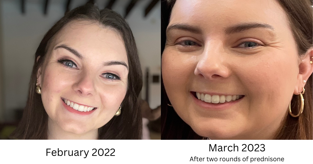 My Ulcerative Colitis Treatment Made Me Unrecognizable. Now I’m