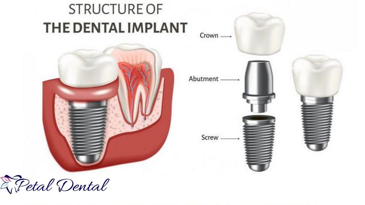 Implant Crowns and Root Canals A Comprehensive Guide to Dental Health and Restoration in