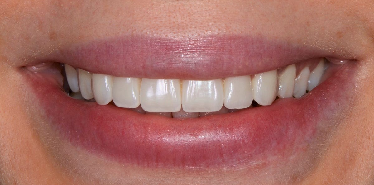 The good, the bad, and the ugly of dental porcelain veneers by Costin