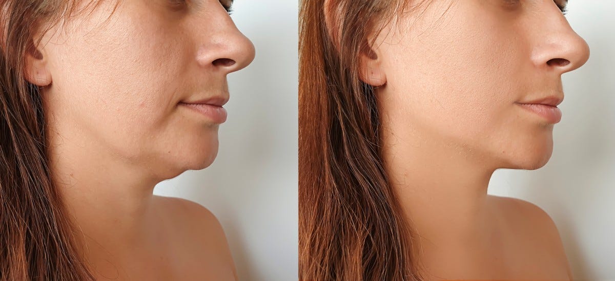 Say Goodbye to Double Chin with RF Microneedling Effective Ageing Neck