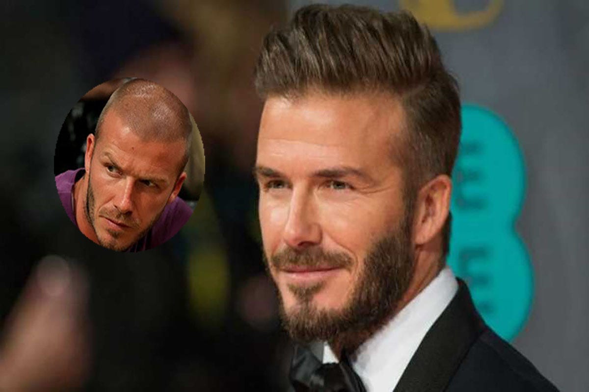 celebrity hair transplant before and after by best clinic Medium