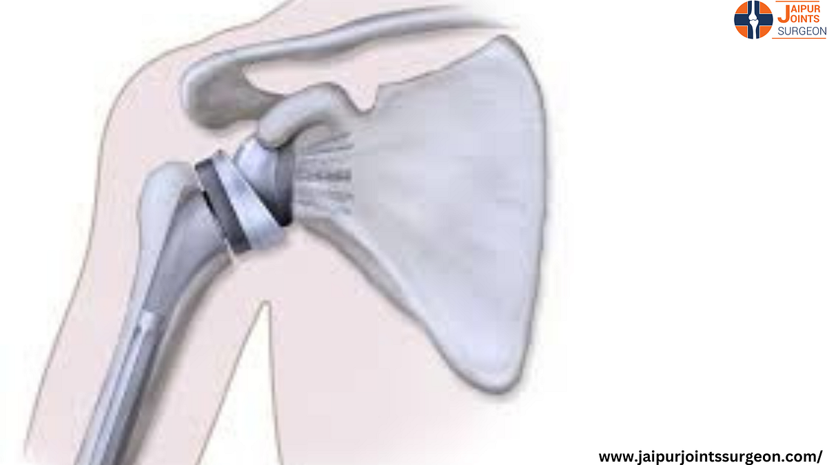 Best Shoulder Replacement Surgeon In Malviya Nagar by Dr Ashish Rana