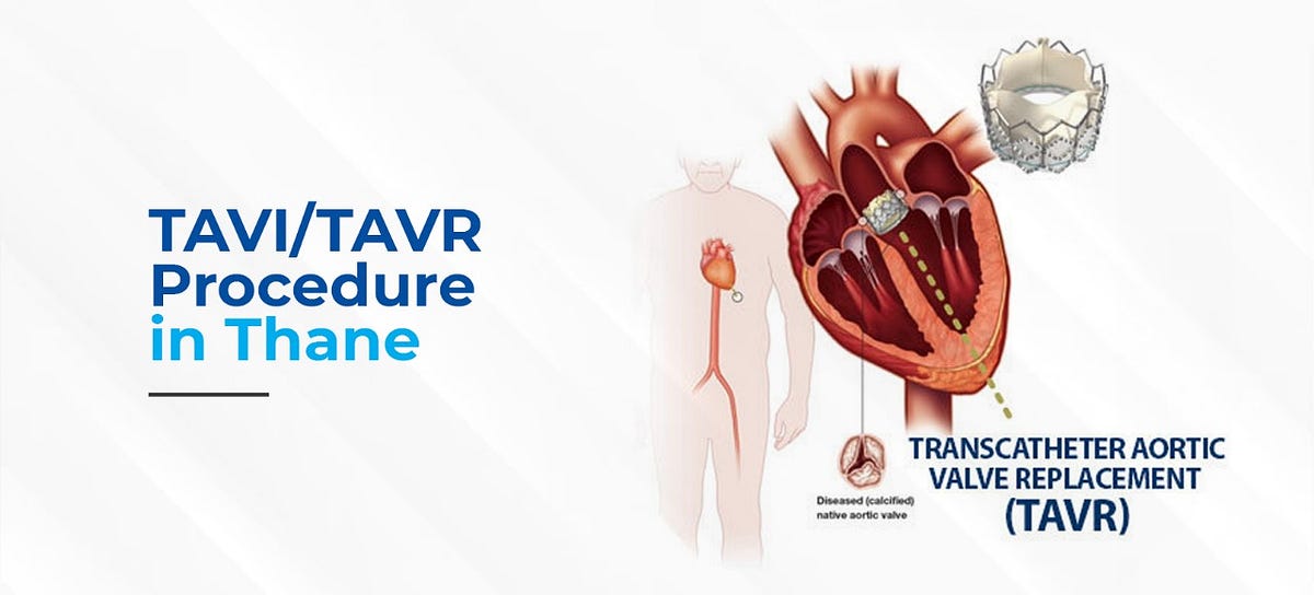 TAVI / TAVR — Life-Saving Heart Procedure Now Available at Jinkushal ...