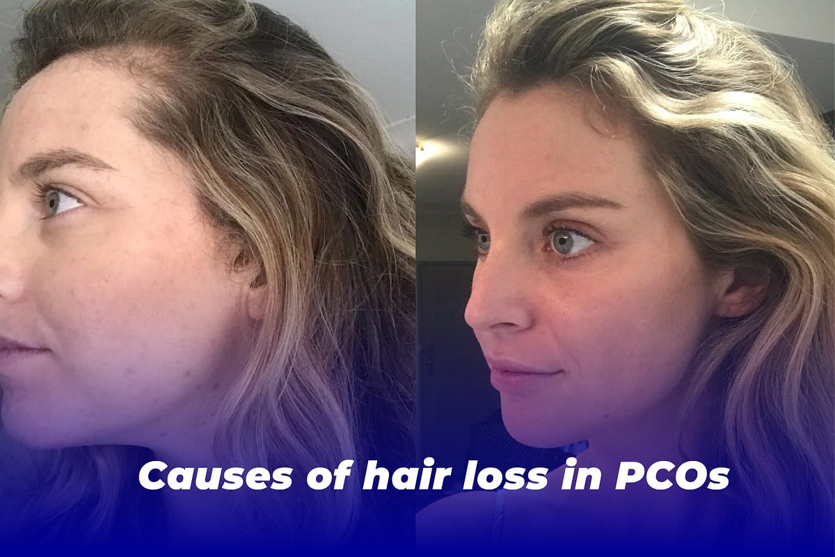 causes-of-hair-loss-in-pcos-before-understanding-the-cause-of-hair