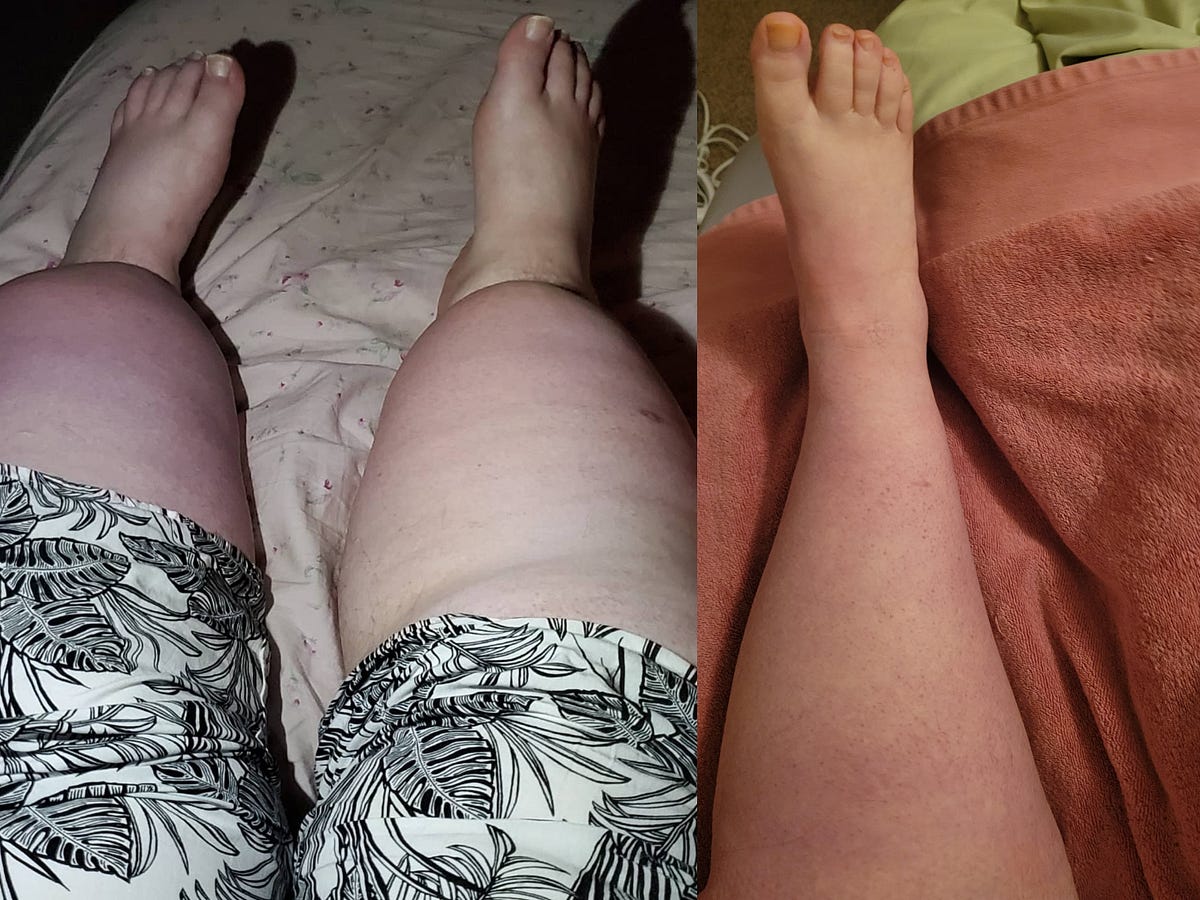 tirzepatide in the thigh Half a Year on Compounded Tirzepatide | by Shannon Ashley | Honestly Yours