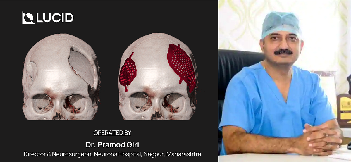 Titanium Cranioplasty — A Case Study by Dr. Pranav Sapkal LUCID
