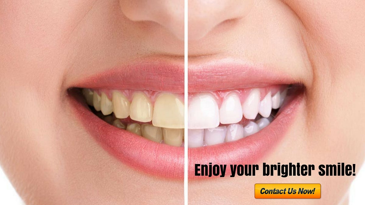 Most Popular Cosmetic Dental Procedures by Plantation Dental Care