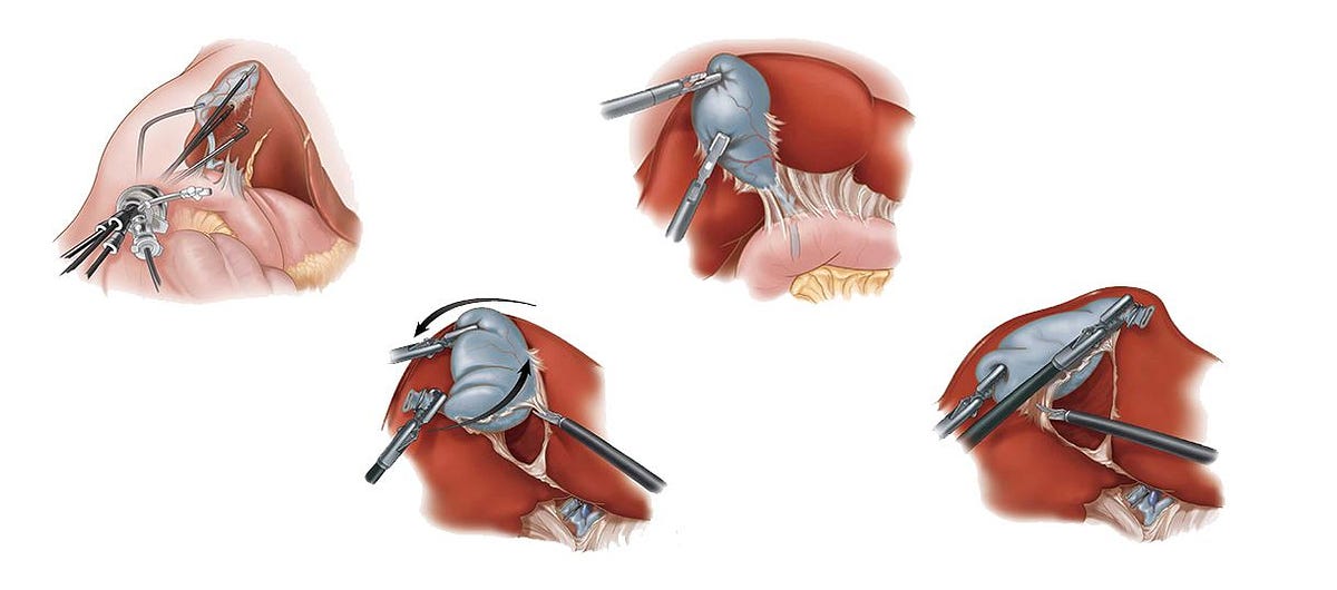 Laparoscopic. Cholecystectomy & Gallbladder removal… | by Tipshealth ...