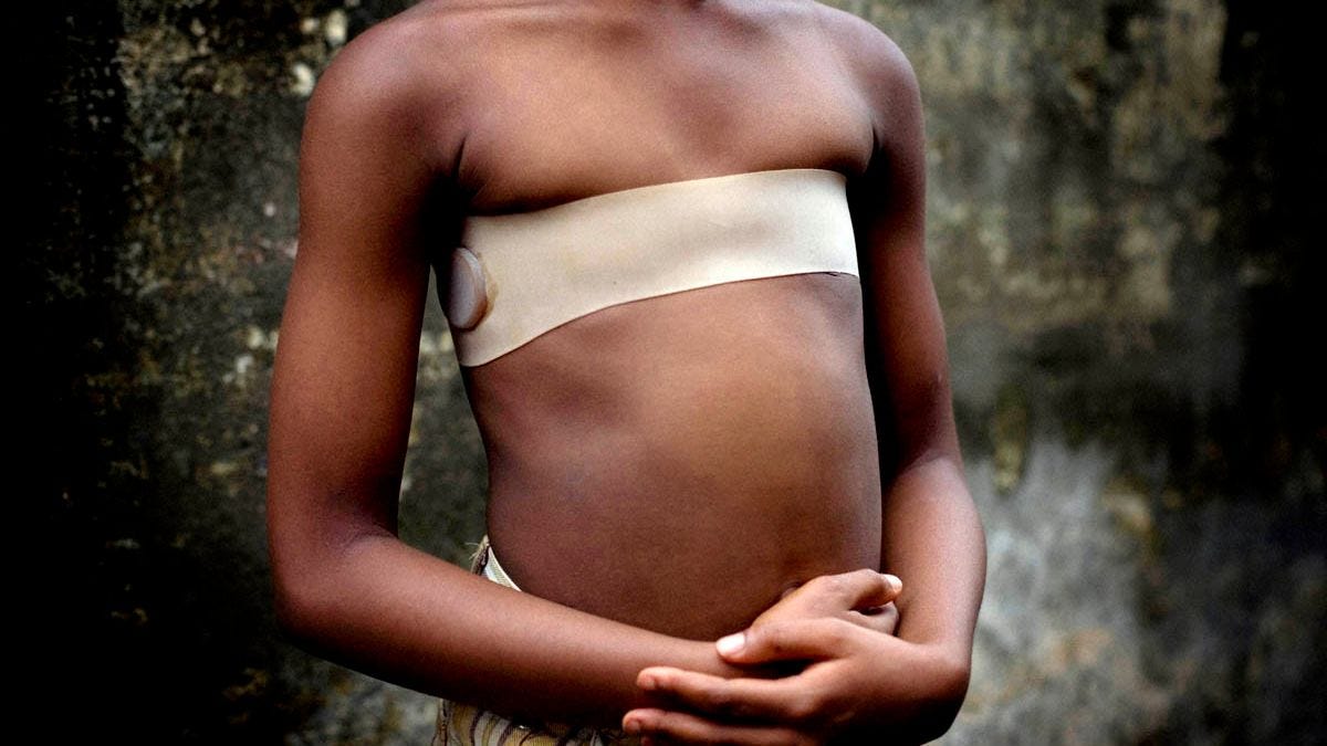 The Horrifying Practice Of Breast Ironing In Africa