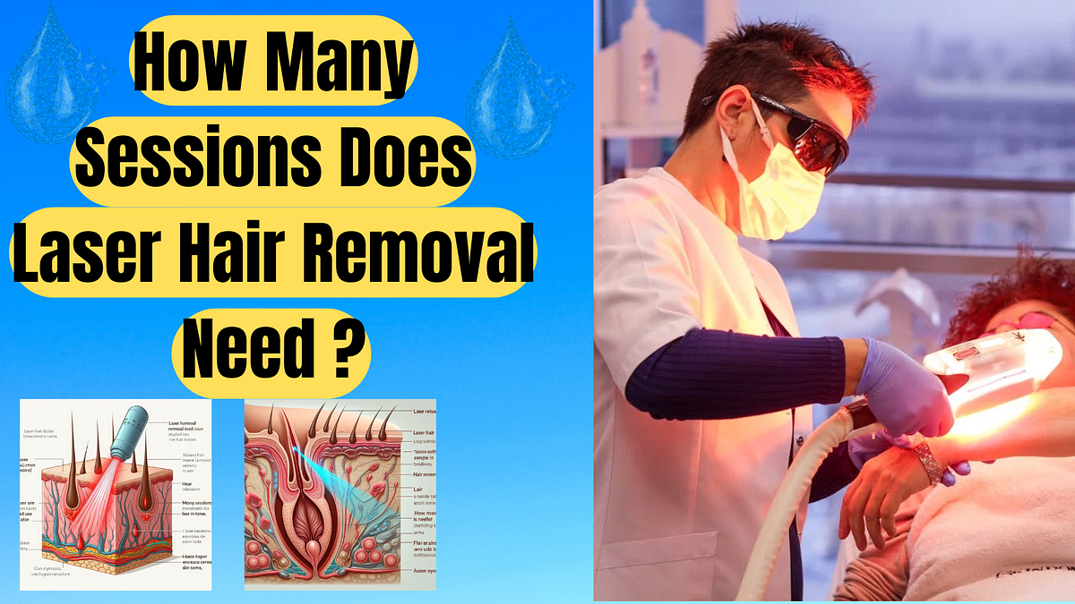 How Many Sessions Does Laser Hair Removal Need ? A Comprehensive Guide