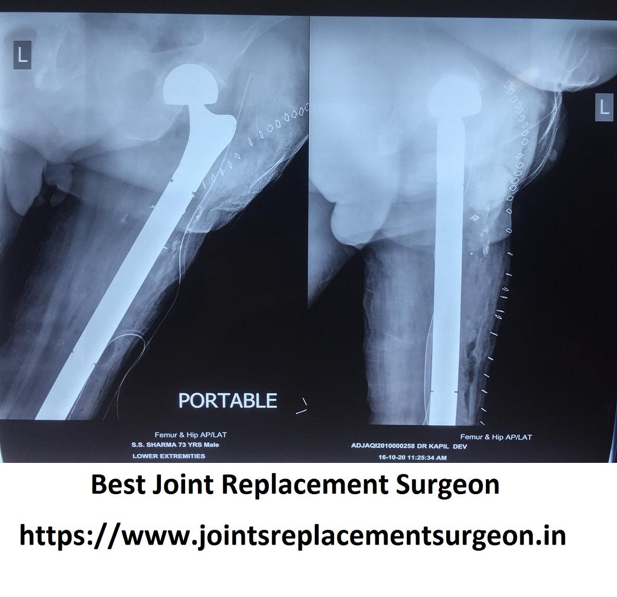 How To Recover Hip Fracture?. What is a hip fracture? by Joint Jaipur