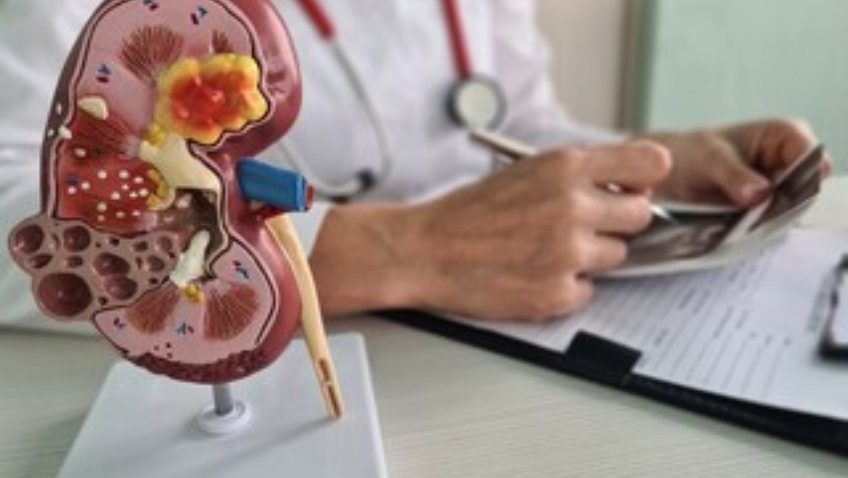 Optimal Water Intake for Kidney Stone Patients Debunking Myths and