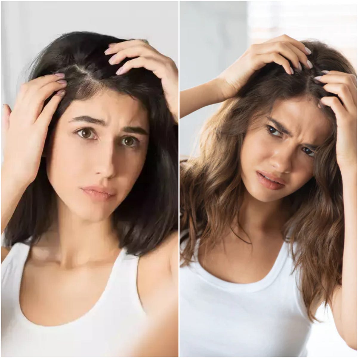 Home Remedies for Oily Dandruff Effective Solutions for a Healthy