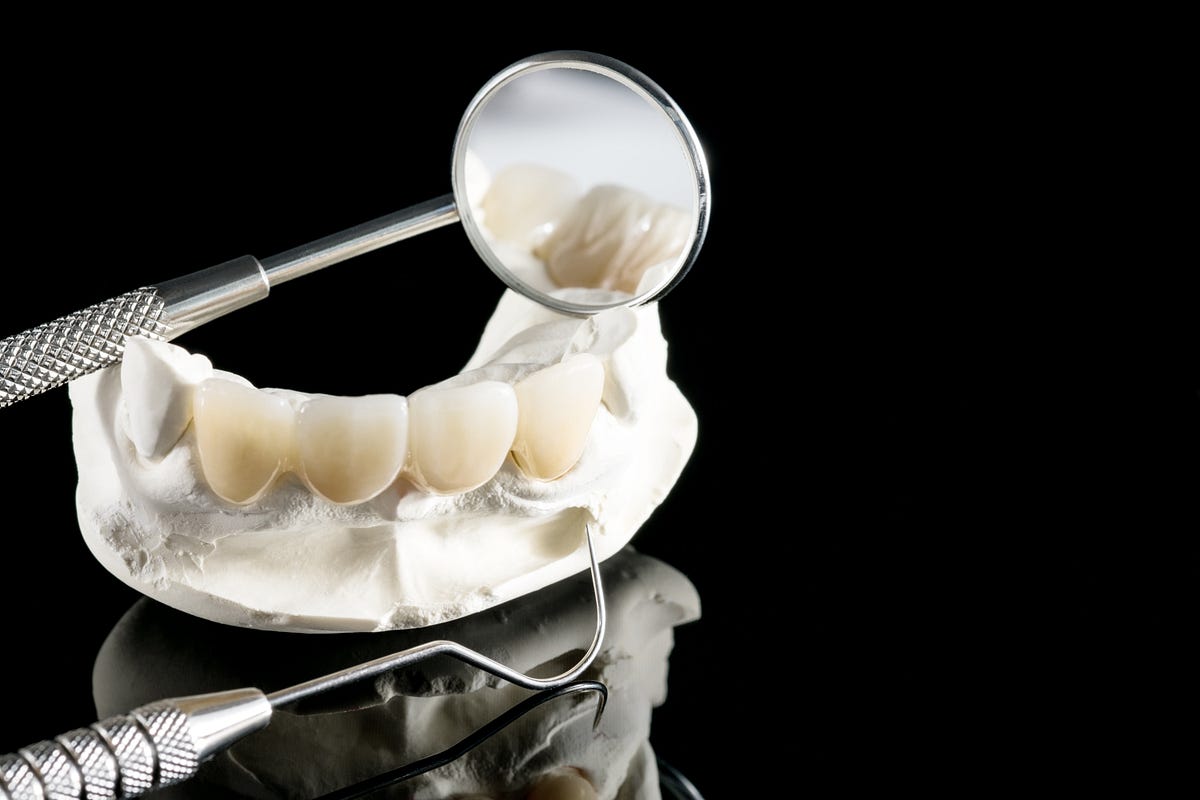 Adhesive Bridge Preparation. An adhesive bridge is one that involves