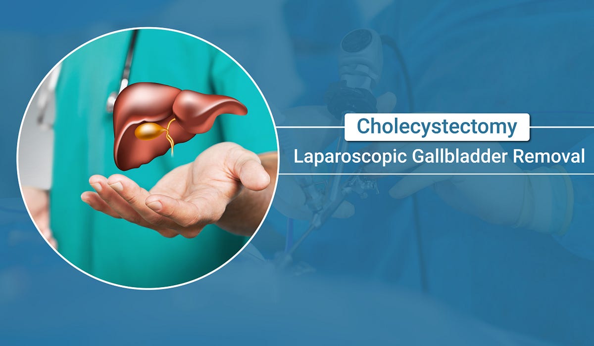 laparoscopic gallbladder removalLAPAROSCOPIC GALLBLADDER REMOVAL(CHOLECYSTECTOMY) UNDERSTANDING