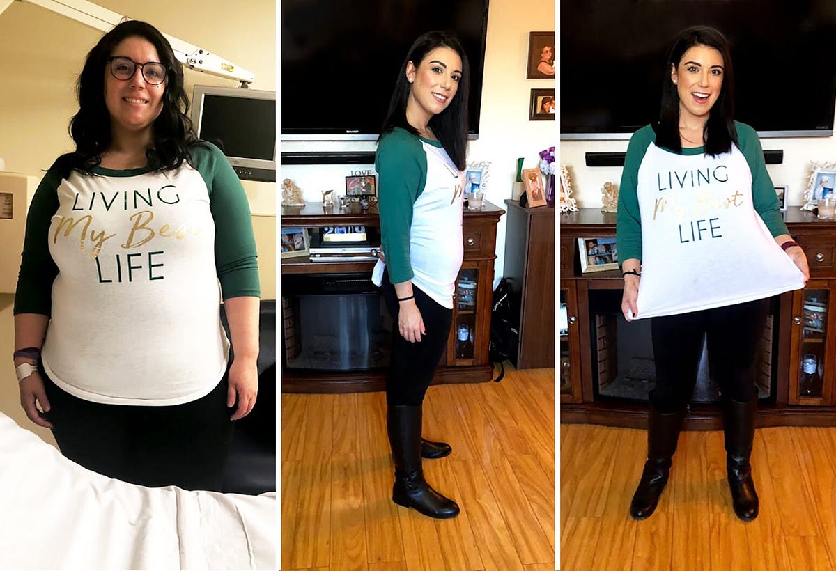which weight loss surgery is best by dr.Krishan Medium