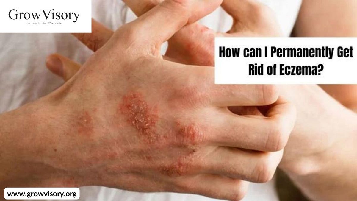 How to cure eczema permanently growvisory org Medium