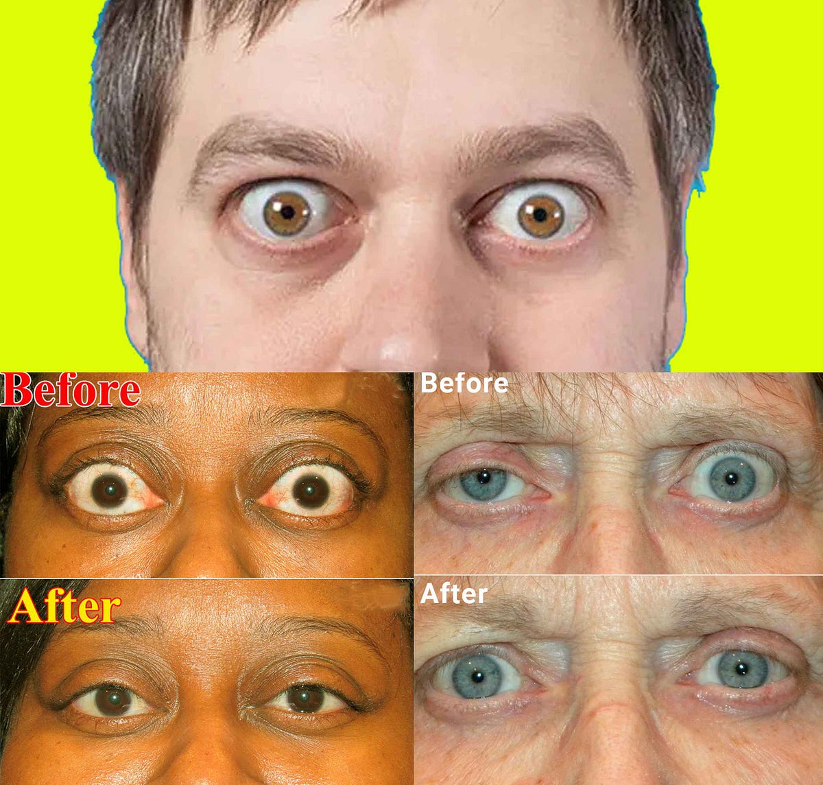 Thyroid Eye Disease Before and After A Comprehensive Guide by Health