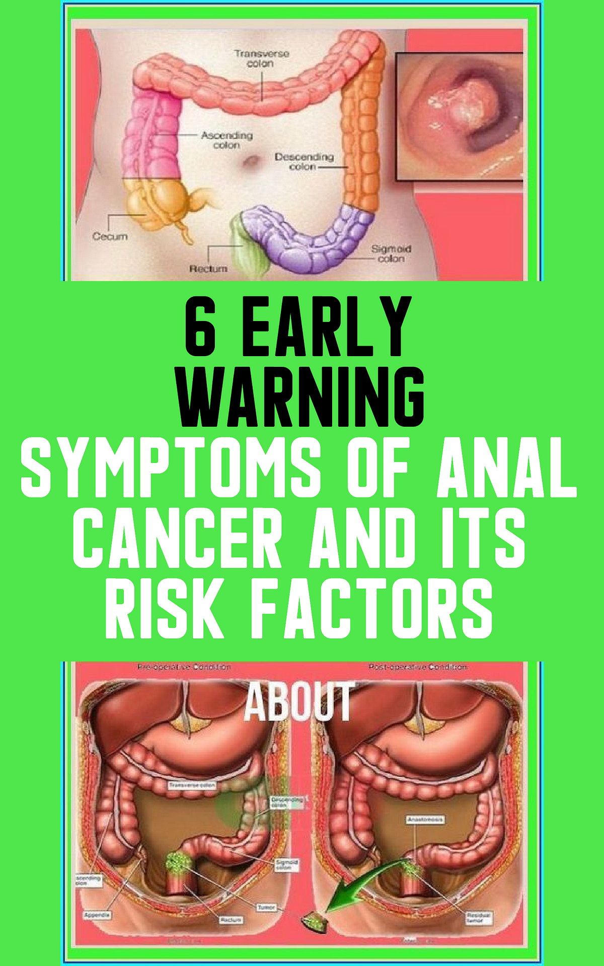 6 Early Warning Symptoms Of Anal Cancer And Its Risk Factors Karentlopezx Medium