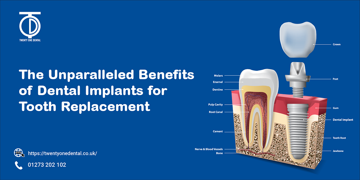 Benefits of Dental Implants for Tooth Replacement TwentyOne Dental by Mark Dental Jun