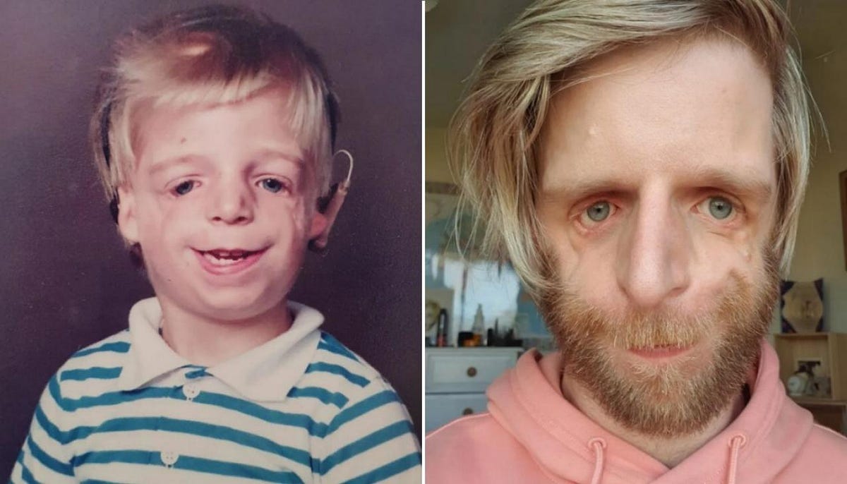 Treacher Collins syndrome My parents abandoned me 36 hours after I was