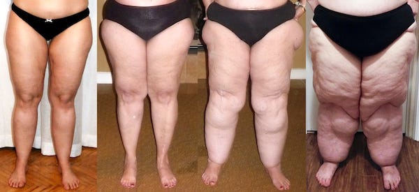 Skinny with large legs? Look into it | by Lipedema Journal | Medium