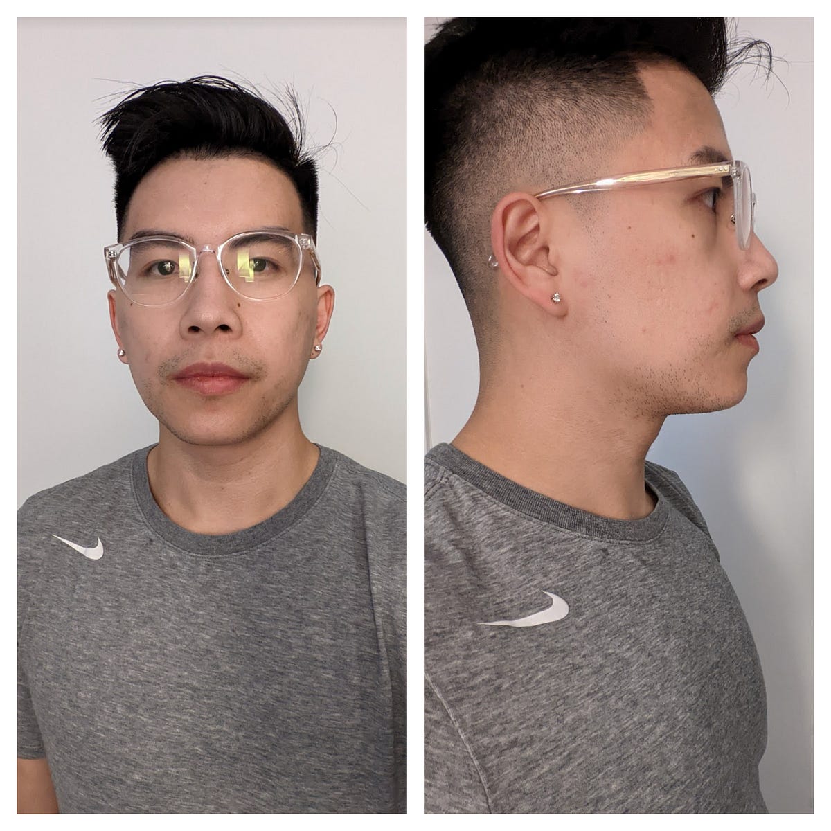 Preparation post for jaw surgery candidates Medium