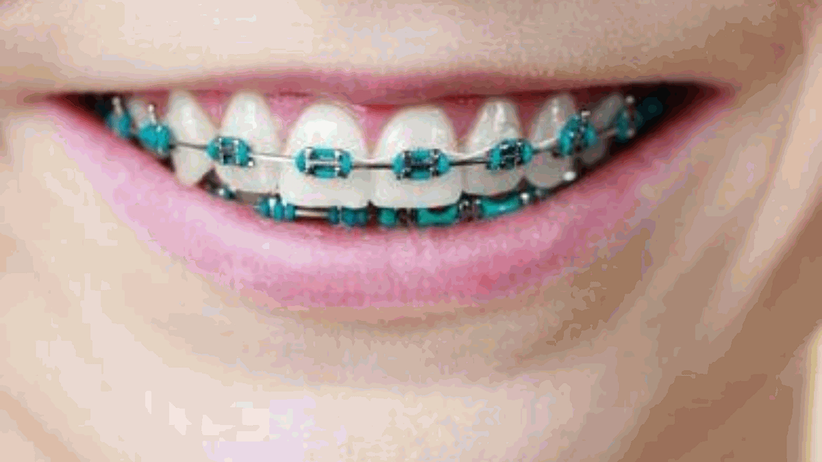 Light Blue Braces Benefits, Risks, and Cost by urooj noor Medium