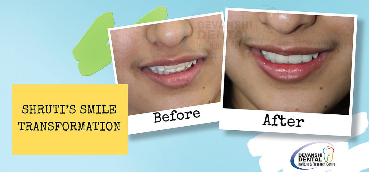 How Long Do Veneers Last on Your Teeth? Unveiling the Secrets to a