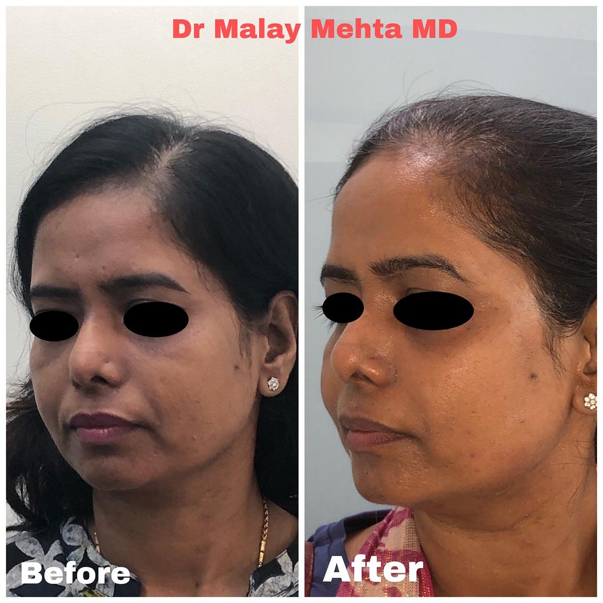 Malar Festoon and Smile Lines. Malar festoon is an early sign of aging