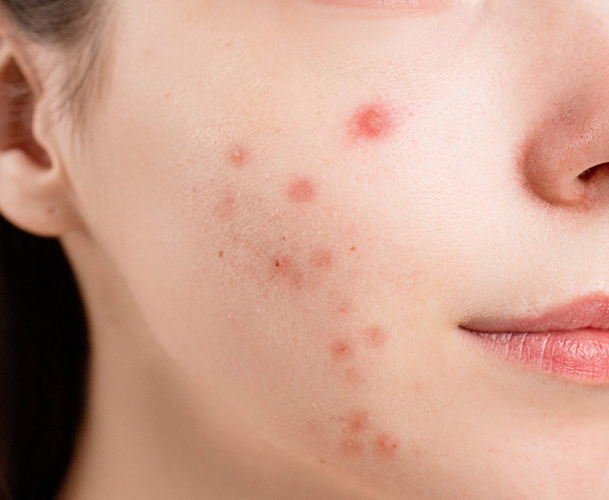 How to clear Acne quickly and Naturally by Infomaniac Medium