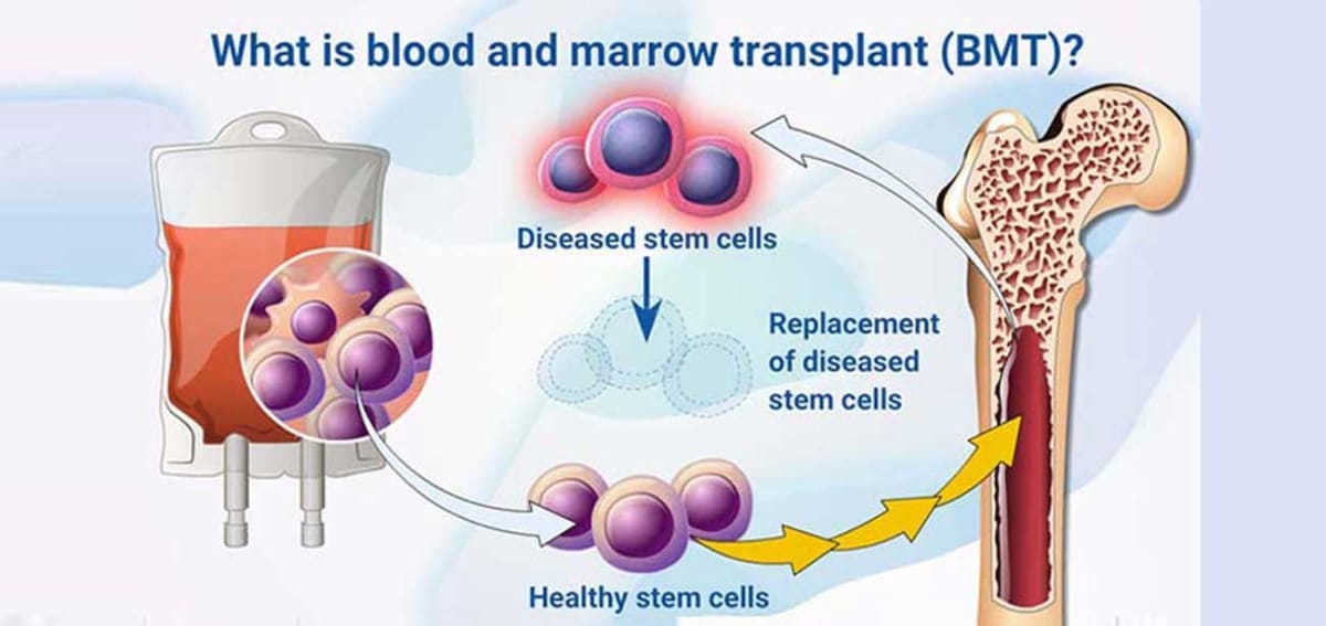 Regenerating Lives How Stem Cell and Bone Marrow Transplants Restore