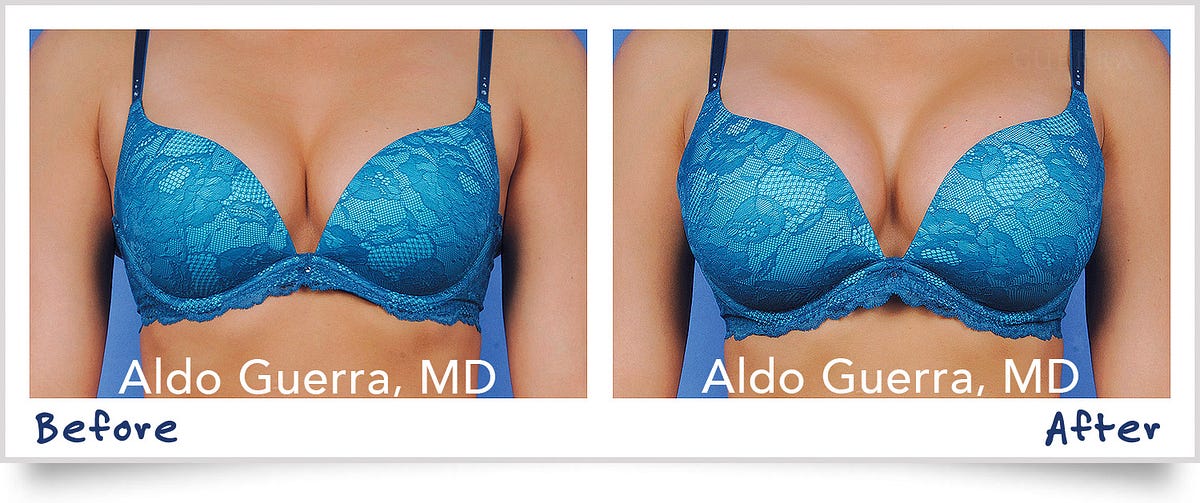 Can you wear underwire bras after breast augmentation? Absolutely