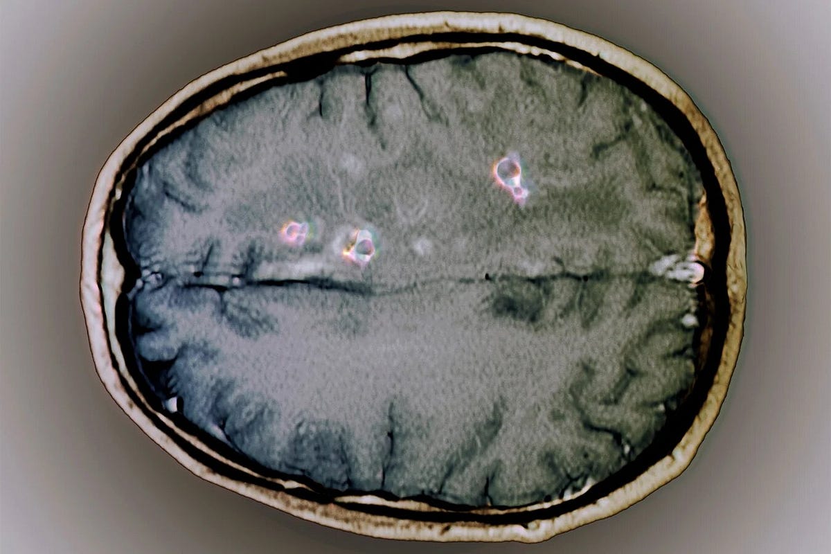 Eating Raw Pork & Bacon Could Infect You with Brain Worms. by Dr